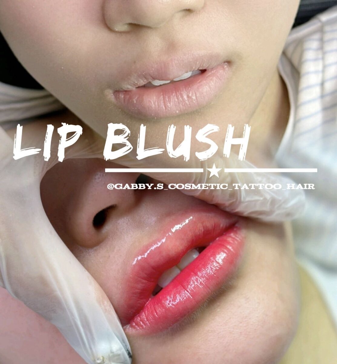 Natural lip enhancement Melbourne - fuller youthful lips
