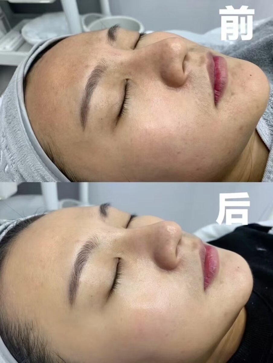 Lumecca Peak treatment results Melbourne