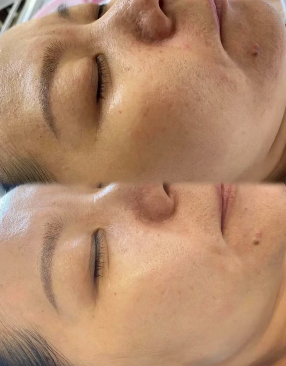 Lumecca with skin booster treatment results Melbourne