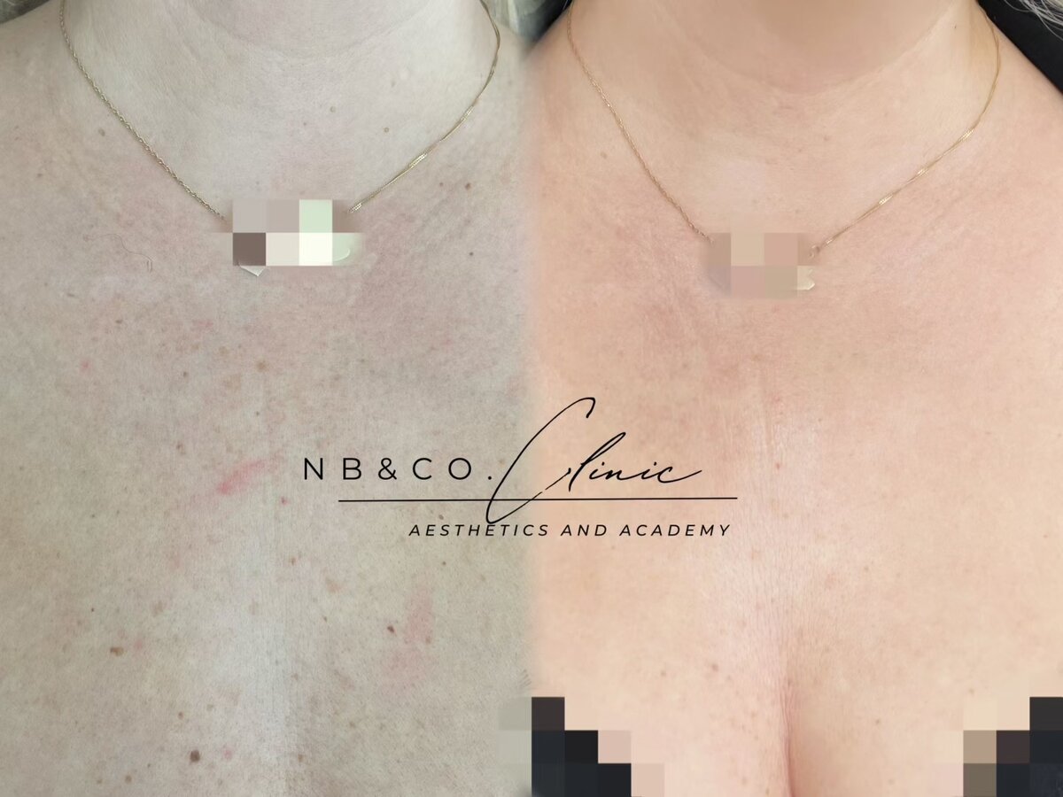 Lumecca pigmentation removal results Melbourne