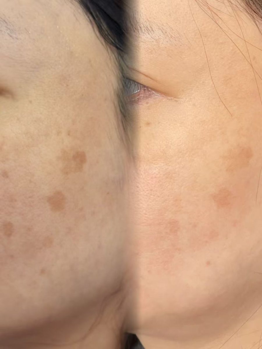 Lumecca Peak cheek pigmentation before and after Melbourne