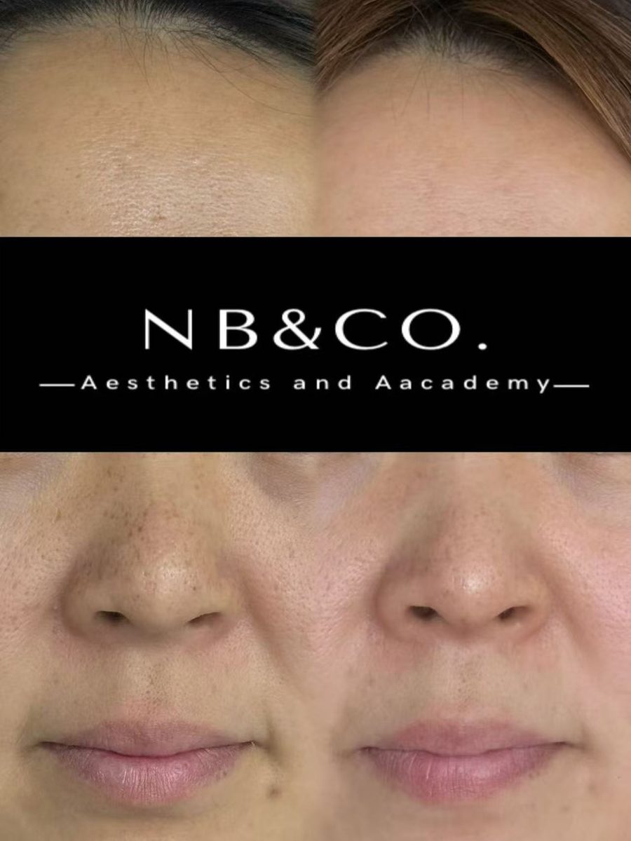 Lumecca Peak nose and forehead pigmentation before and after Melbourne