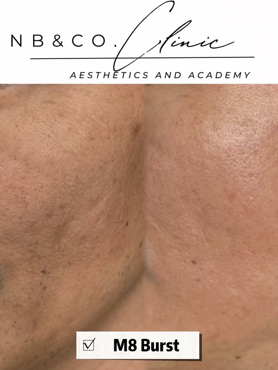 Morpheus8 Burst client results at NB&CO. Melbourne