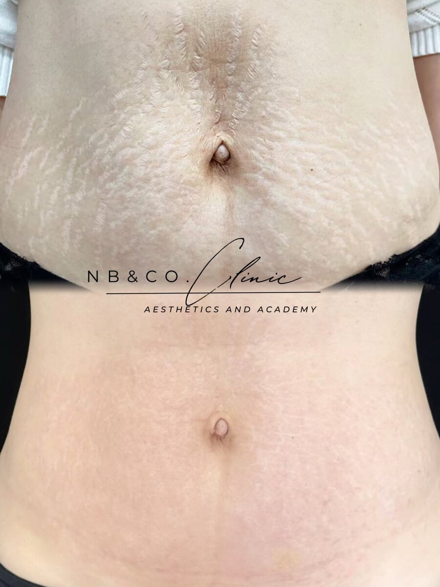 Morpheus8 Burst before and after results Melbourne