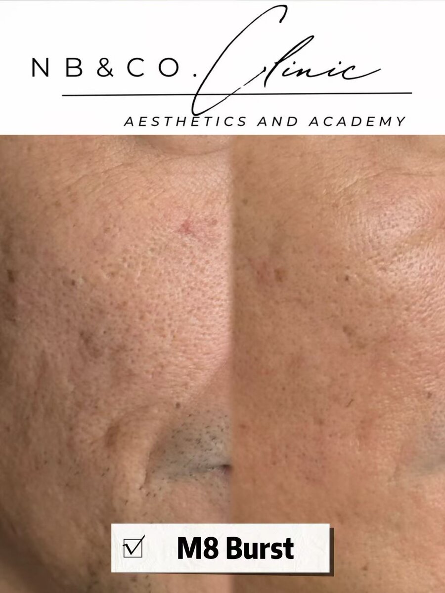 Morpheus8 Burst treatment results Melbourne