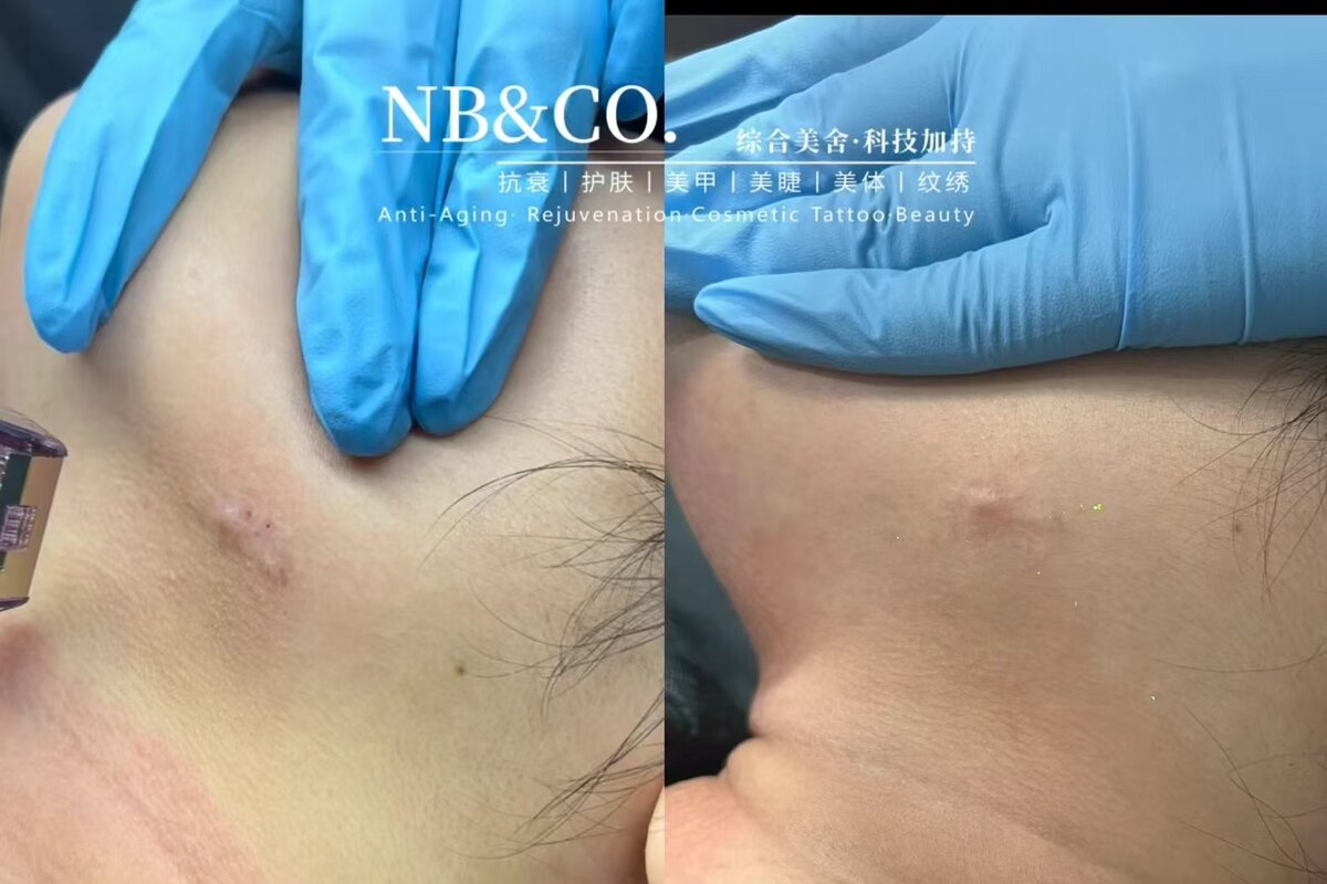 Morpheus8 Burst scar treatment after 1 session Melbourne