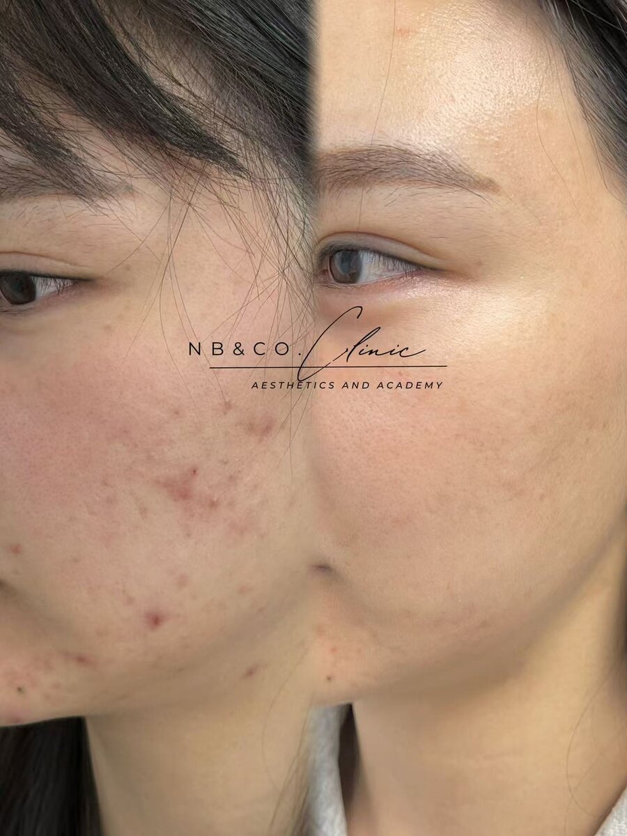 Morpheus8 treatment results Melbourne