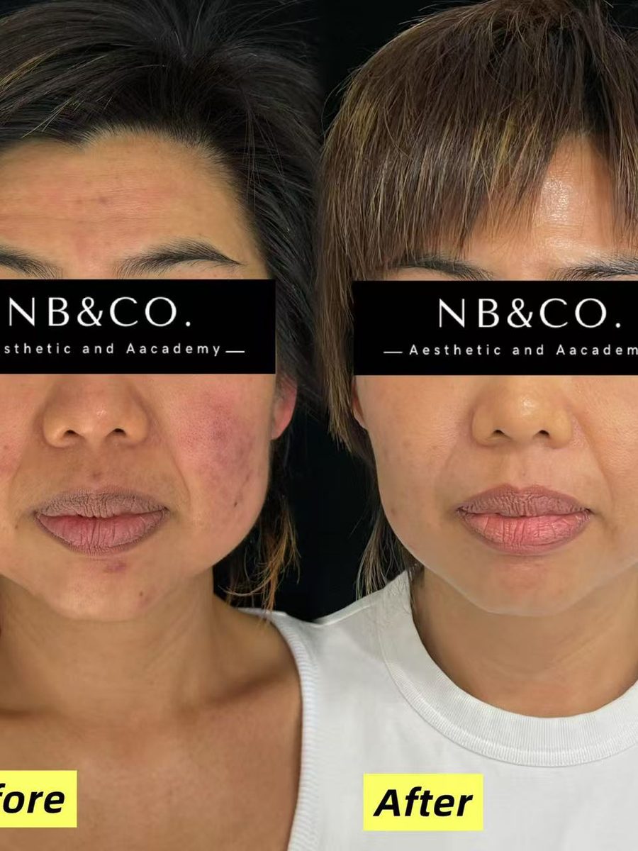 Morpheus8 Burst redness reduction before and after Melbourne