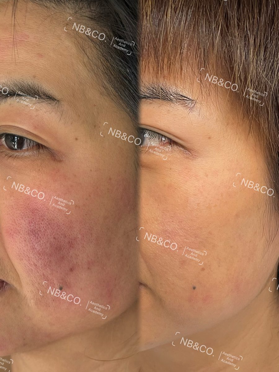 Morpheus8 Burst real client before and after Melbourne
