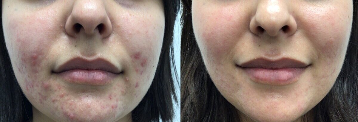 Lumecca Peak acne treatment results Melbourne