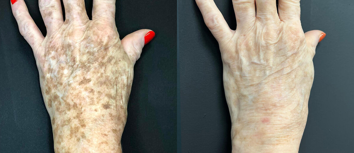 Lumecca Peak body treatment Melbourne