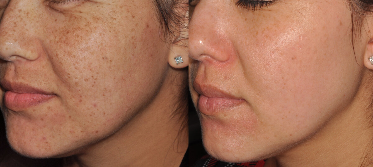 Lumecca Peak pigmentation removal results Melbourne