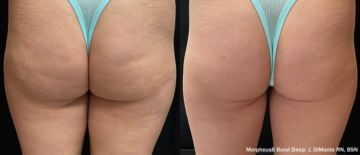 Morpheus8 Burst Deep body contouring results Melbourne