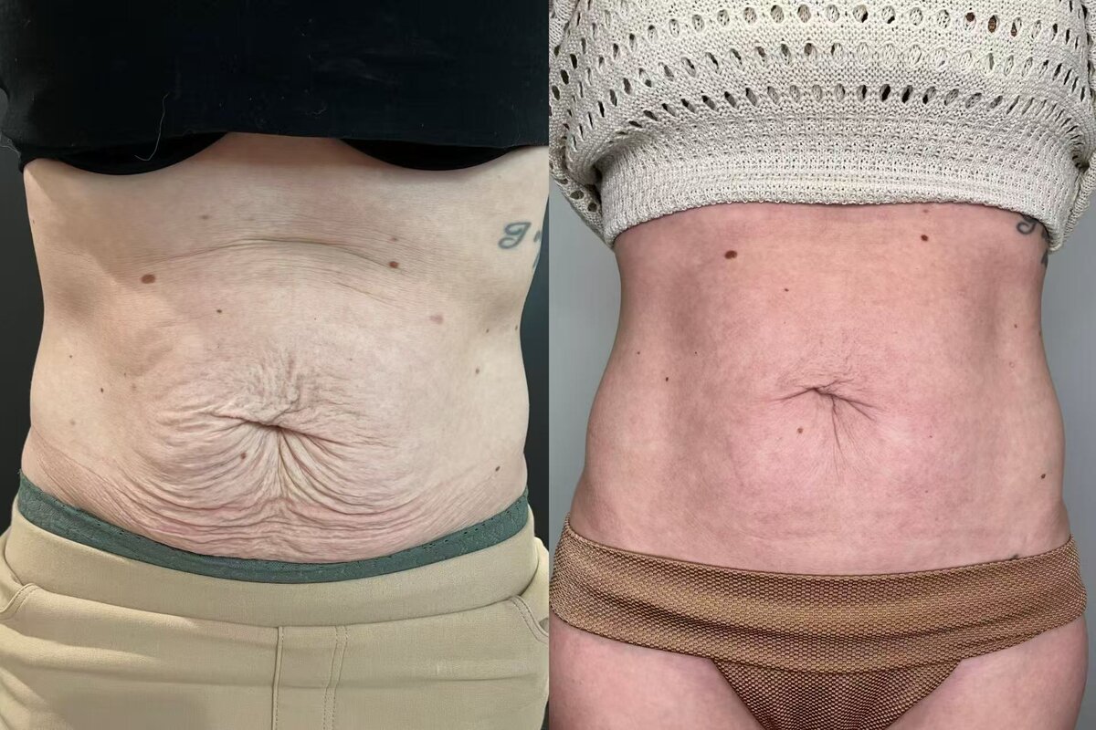 Morpheus8 Burst Deep cellulite reduction Melbourne