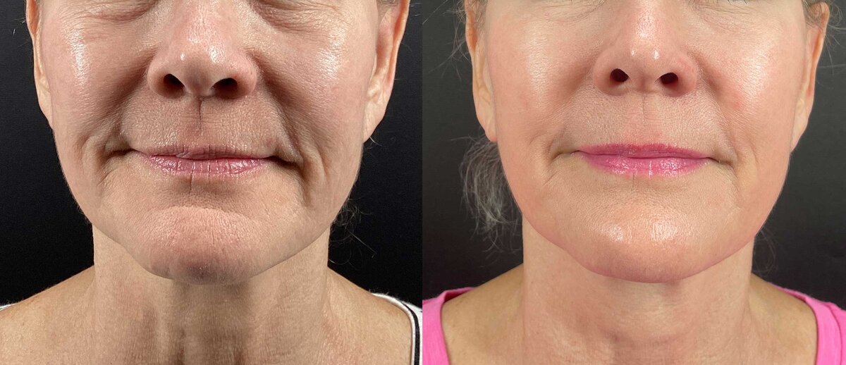 Morpheus8 Burst facial rejuvenation before and after Melbourne
