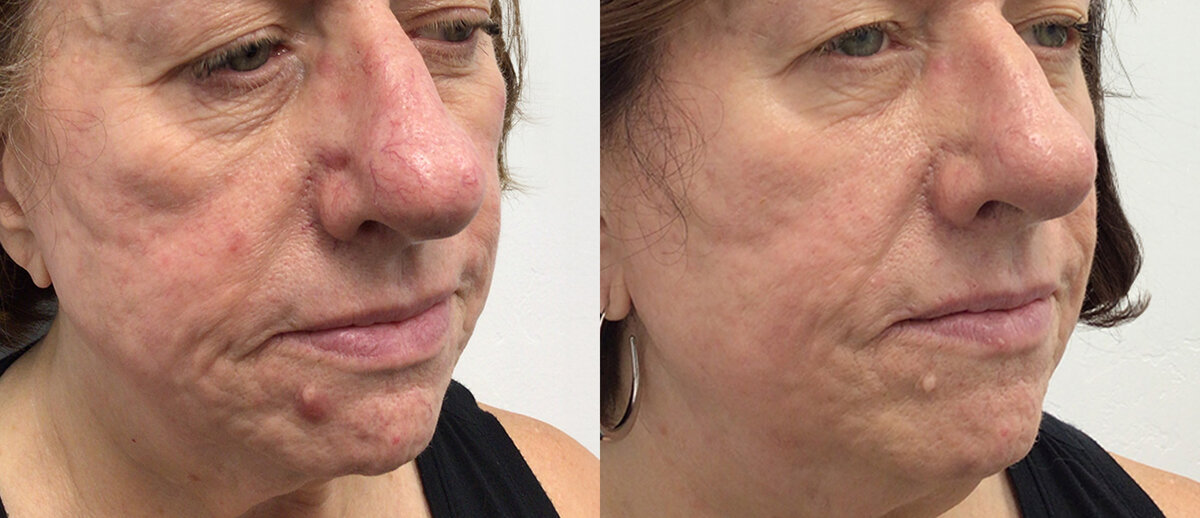 Morpheus8 Burst anti-aging results Melbourne