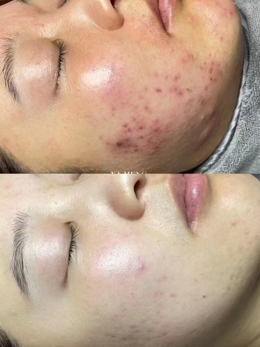 Acne scarring treatment results