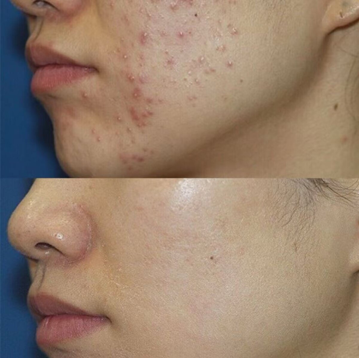 Hormonal acne treatment success