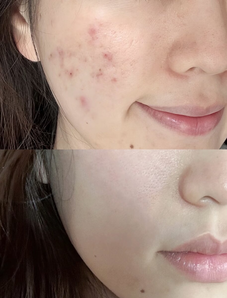 Acne treatment transformation results