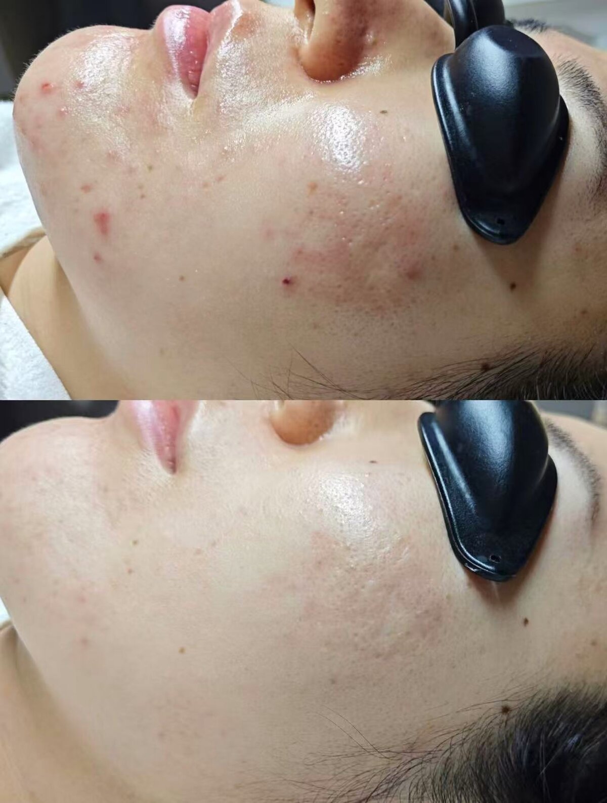 Complete acne clearing transformation