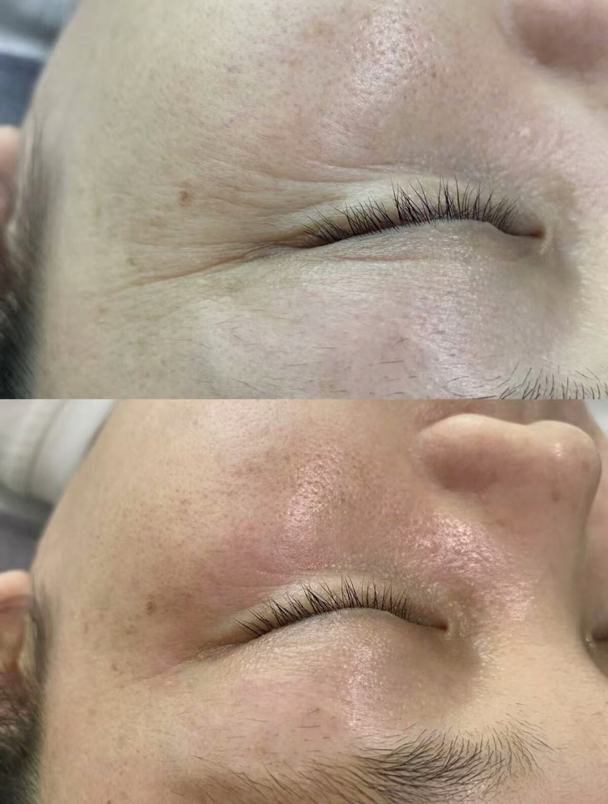 Smoothed Fine Lines & Improved Firmness