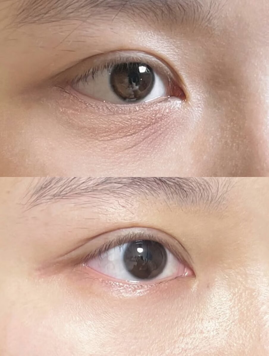 Reduced Wrinkles & Restored Elasticity