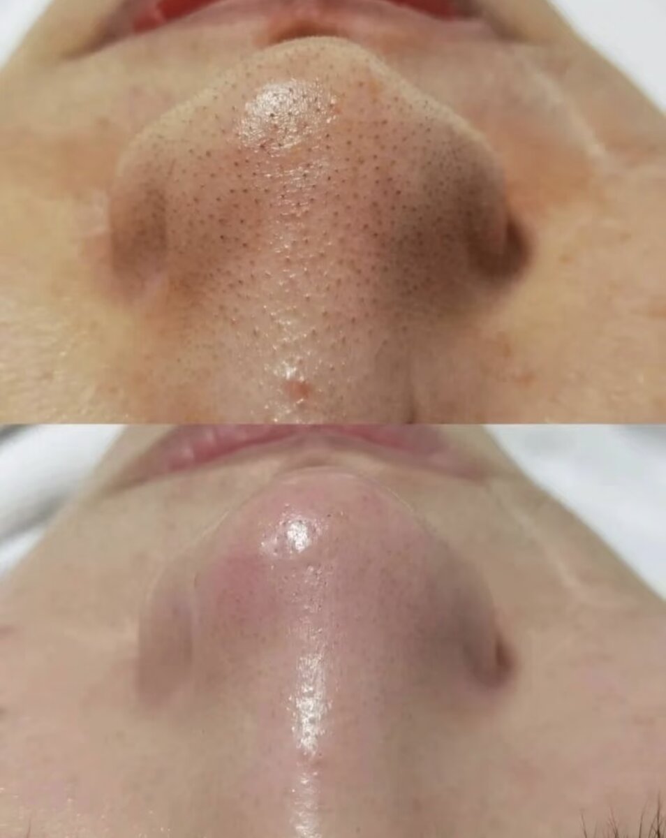 Smoother, Clearer Complexion