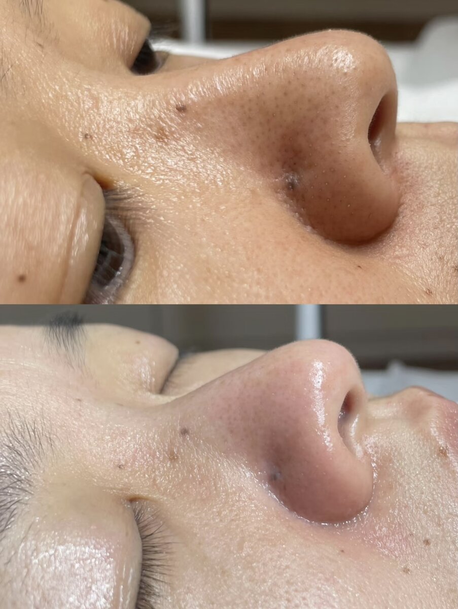 Purified & Balanced Skin