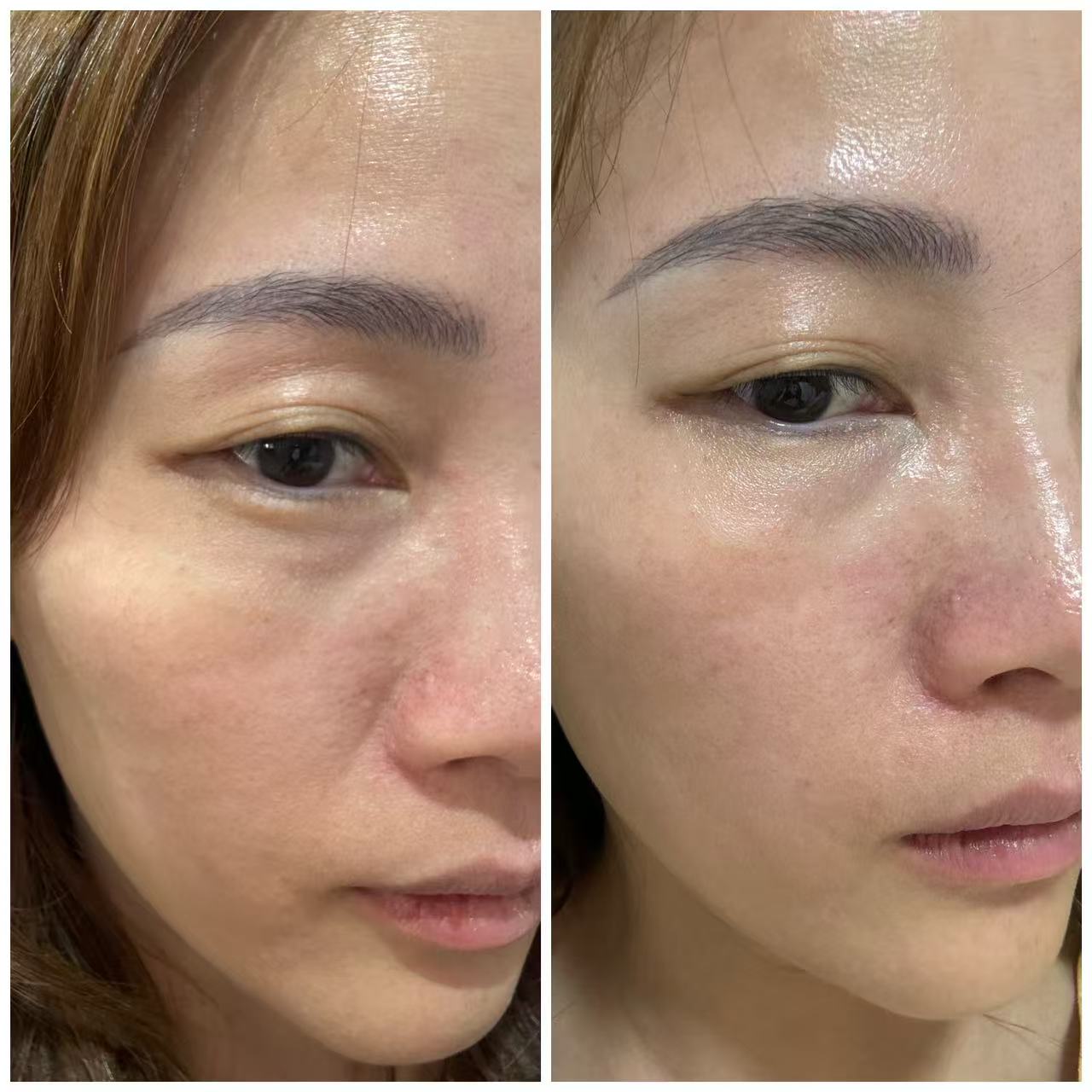 Microneedling before and after result