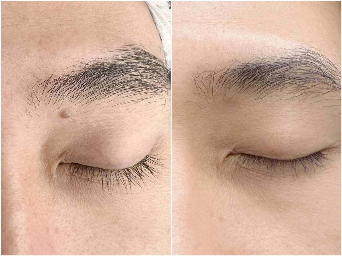 Mole removal before and after results