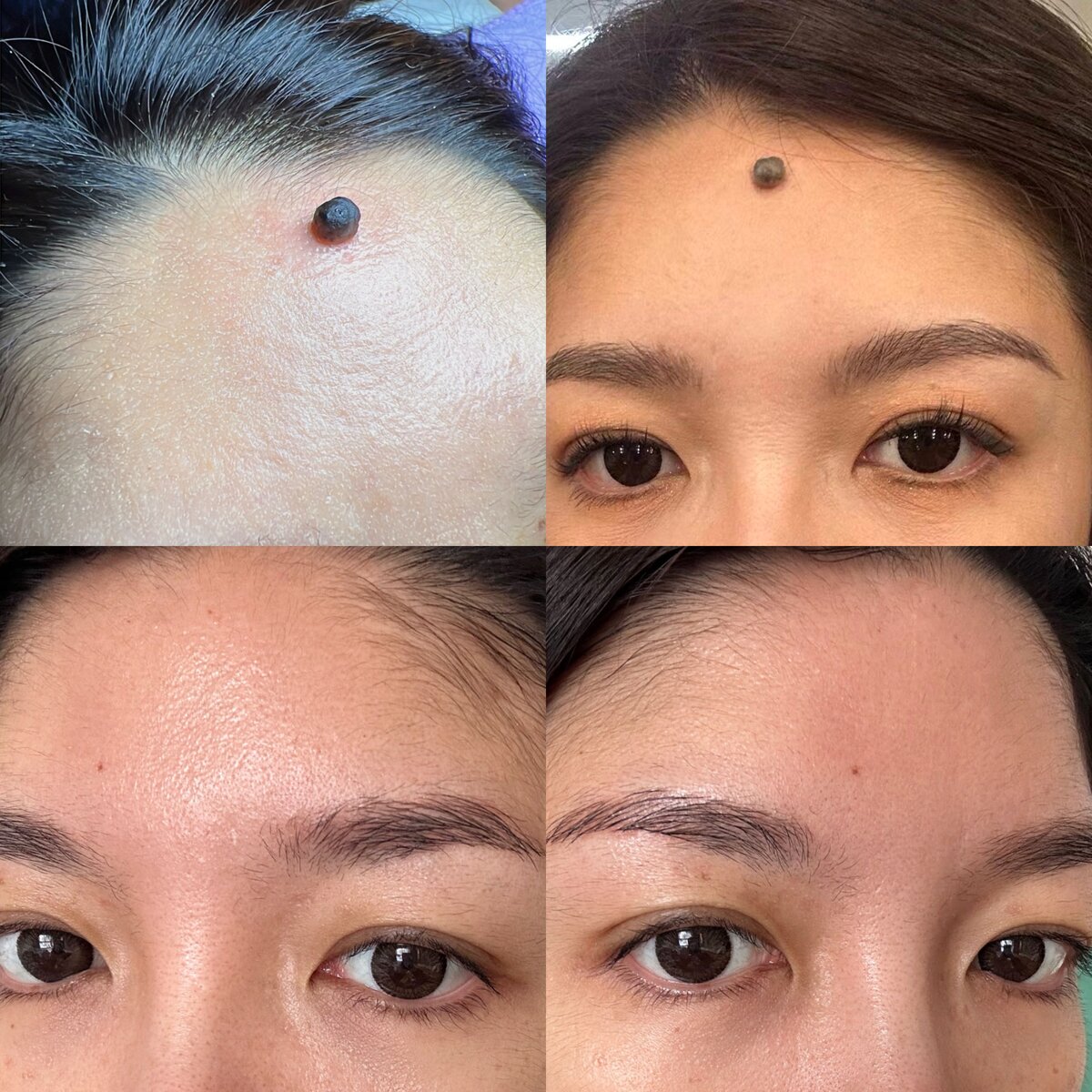 Nevus removal successful results