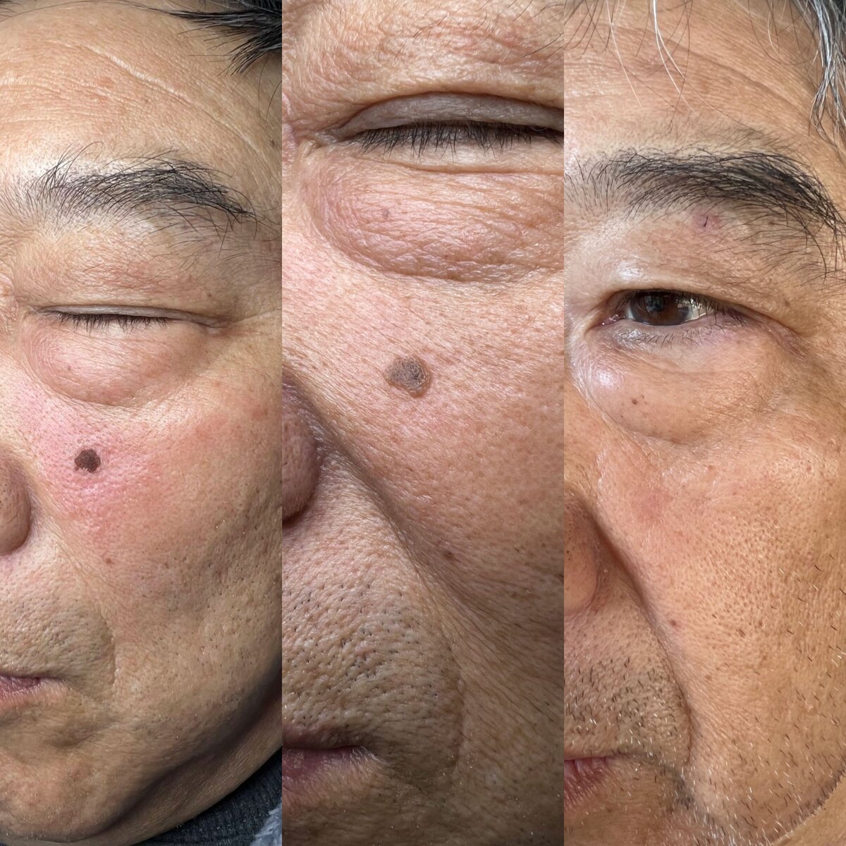 Wart removal treatment results