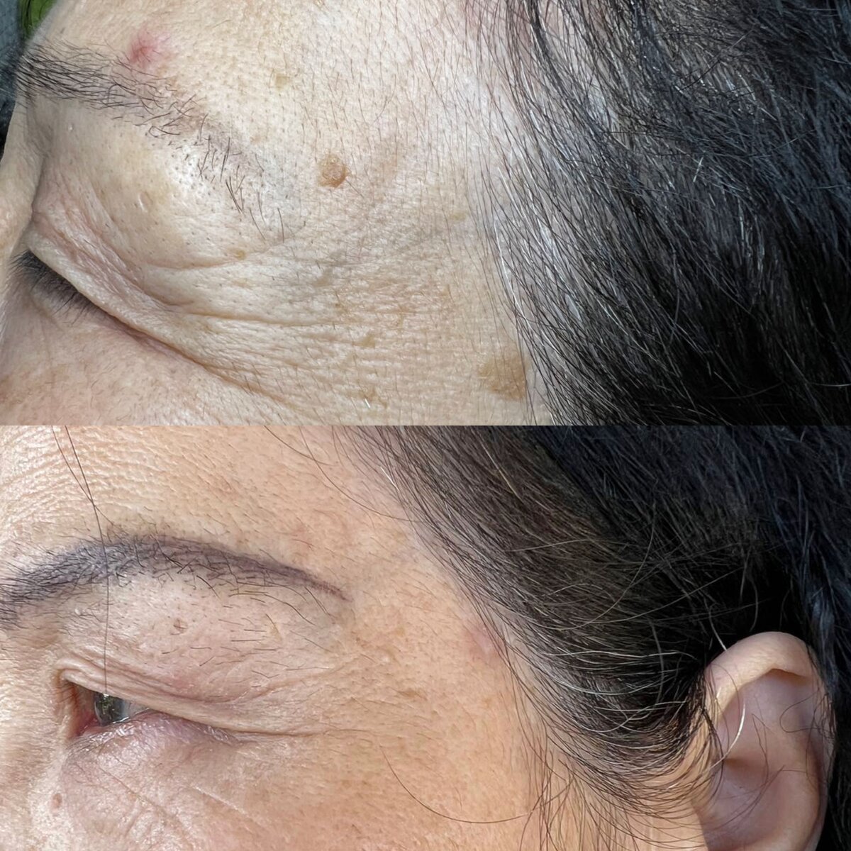 Multiple mole removal results