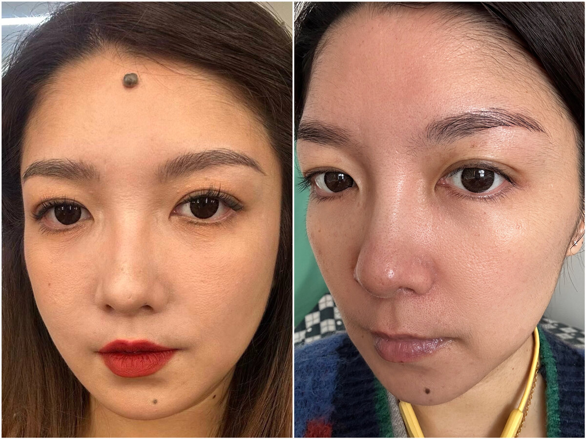Facial mole removal before after