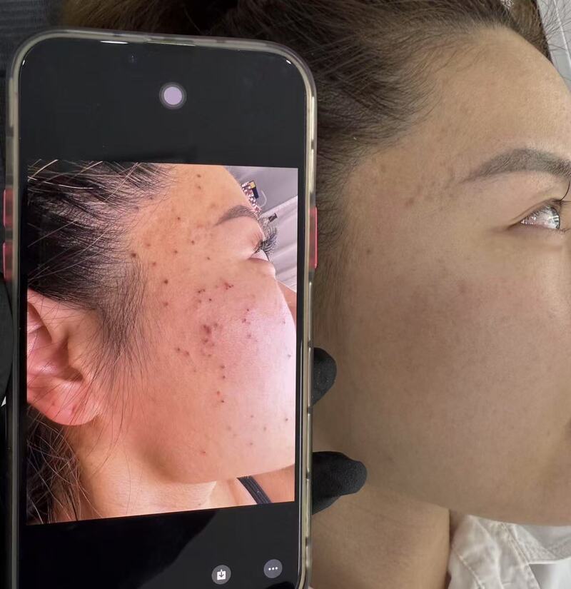 Raised nevus removal results