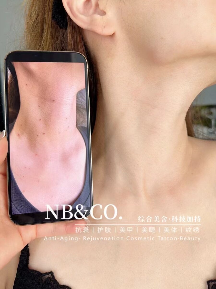 Professional mole removal results