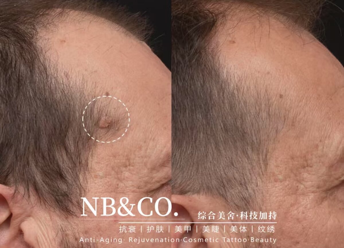 Safe nevus removal treatment