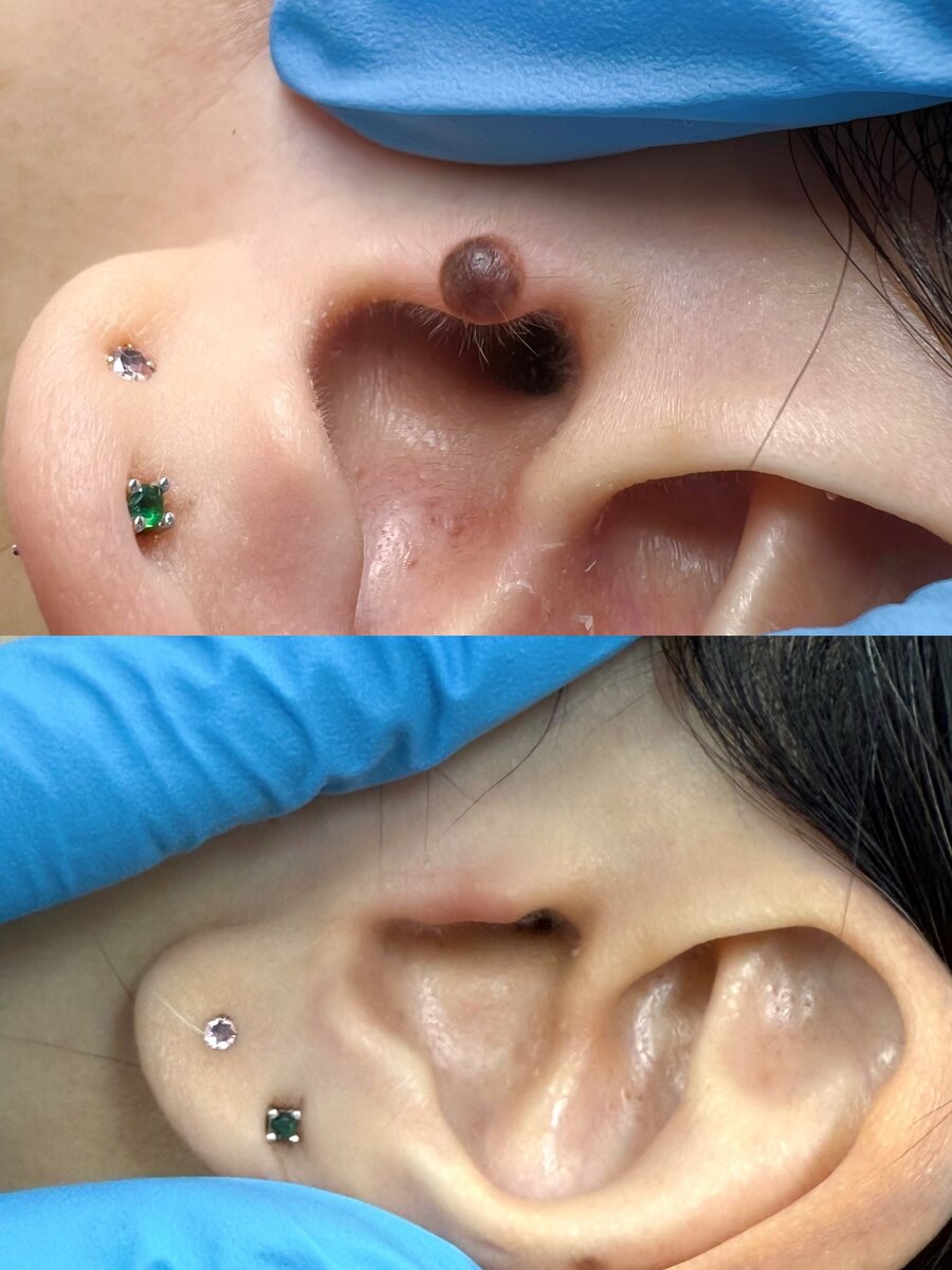 Minimal scarring mole removal