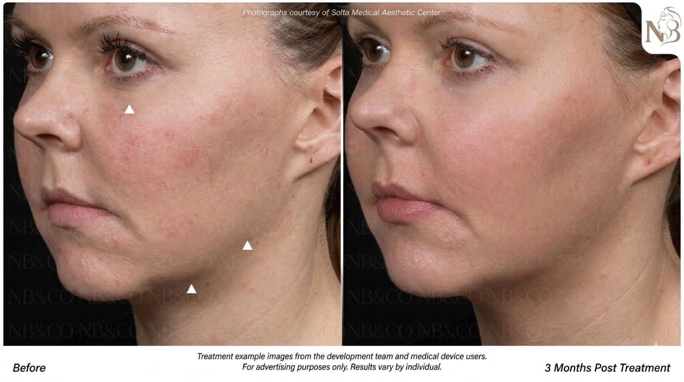 Thermage official result: collagen renewal and redness improvement