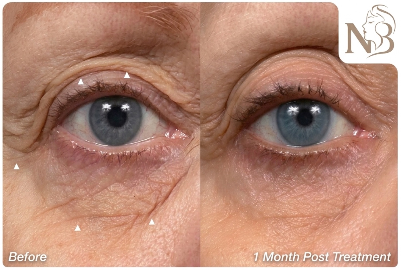 Thermage official result: eye-area fine lines softened 1