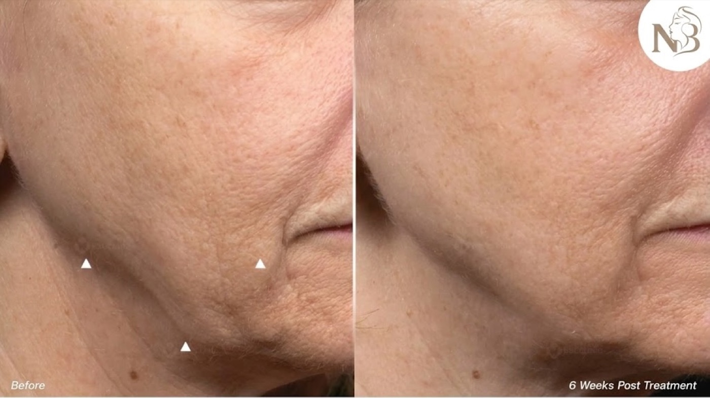Thermage official result: facial fine lines softened 1