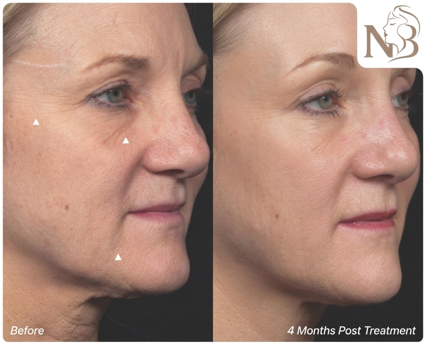 Thermage official result: facial fine lines softened 2