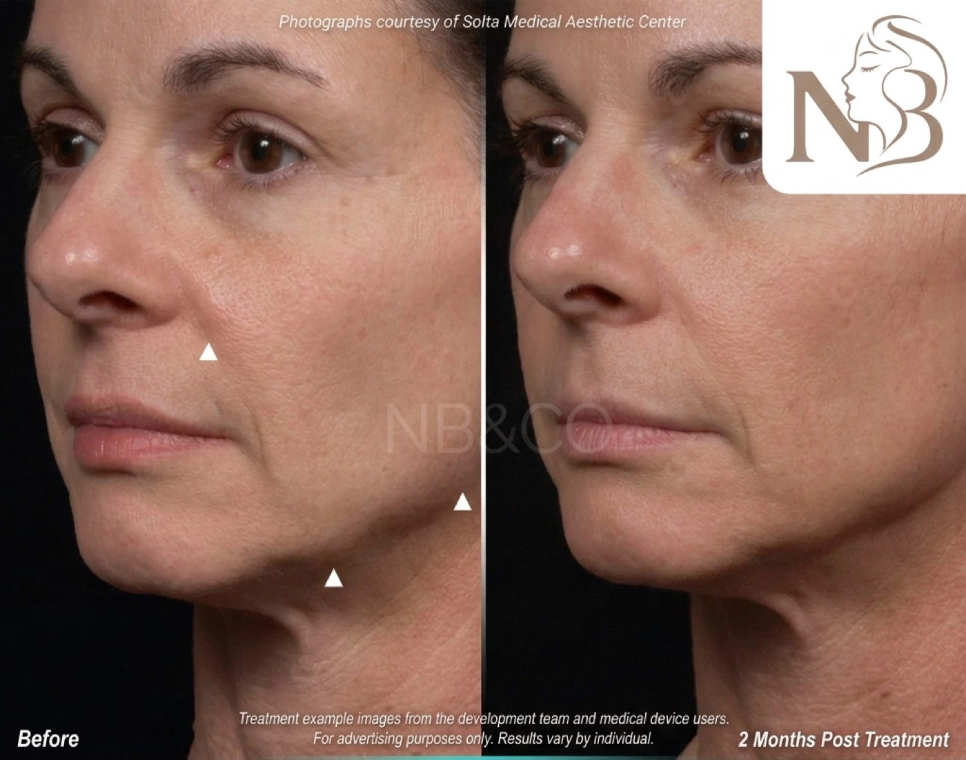 Thermage official result: facial fine lines softened 3