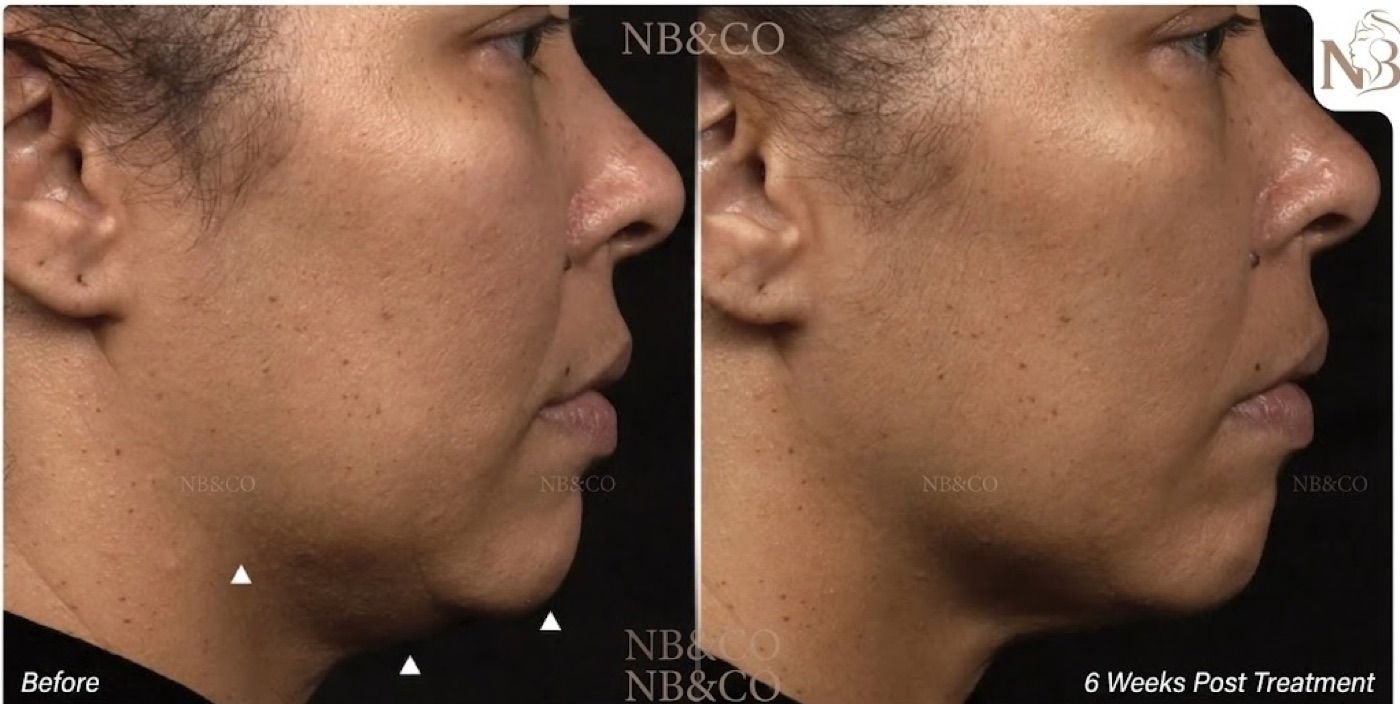 Thermage official result: jawline tightened and mid-face fine lines improved 1