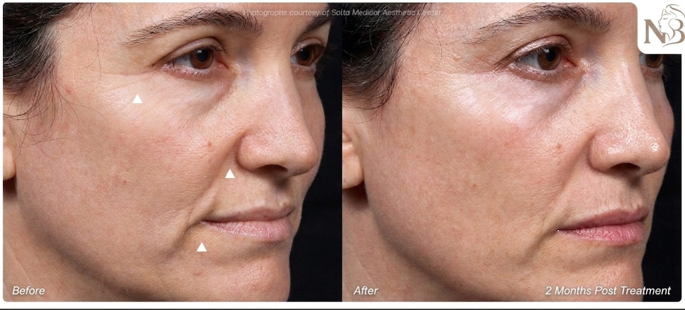 Thermage official result: jawline tightened and mid-face fine lines improved 2