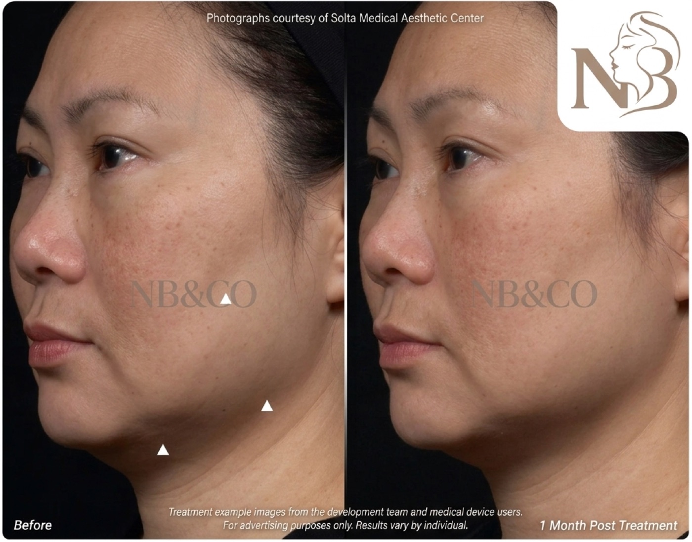 Thermage official result: jawline tightened and mid-face fine lines improved 3