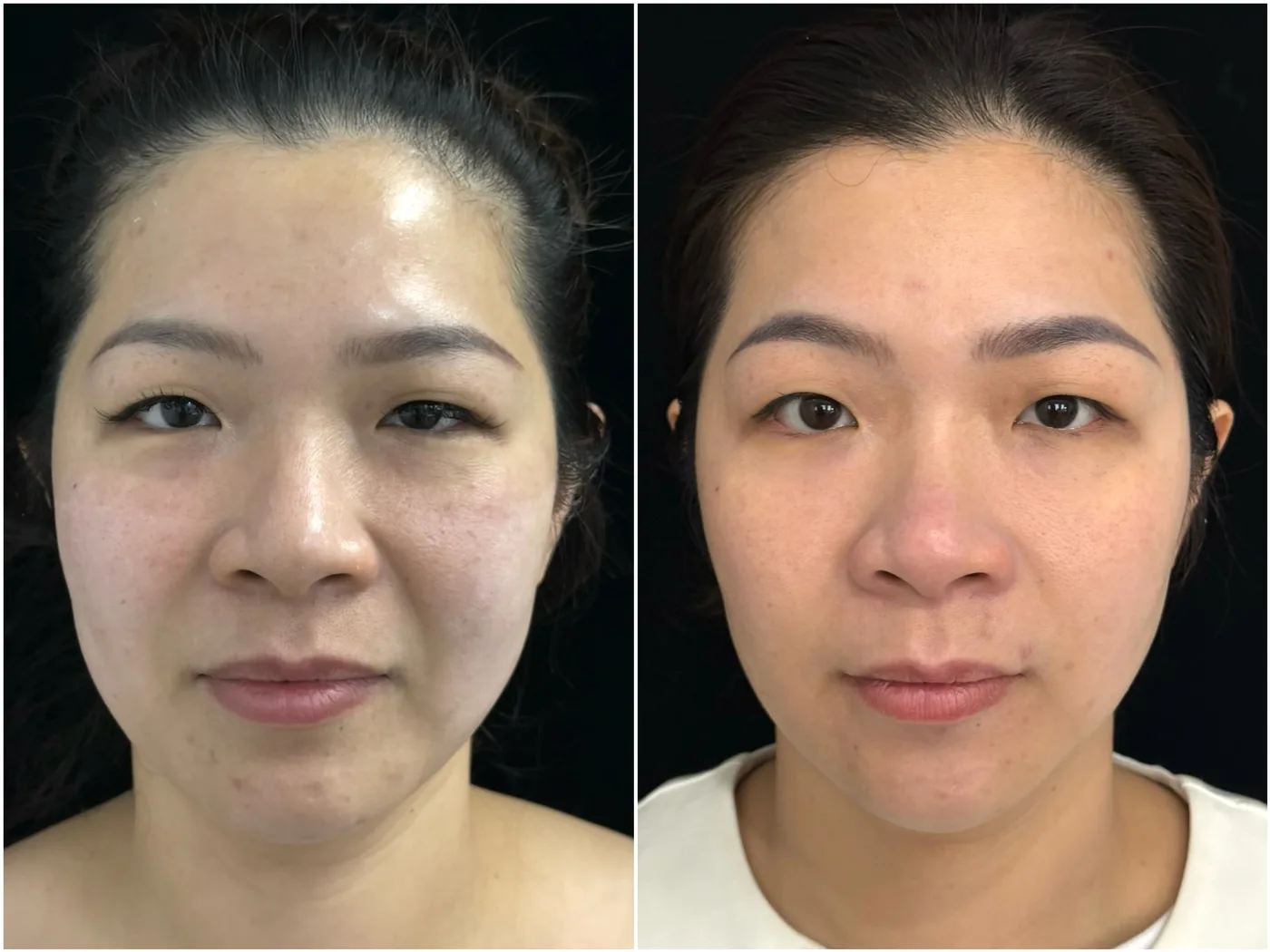 Ultherapy Prime lifting results at NB&CO. Melbourne