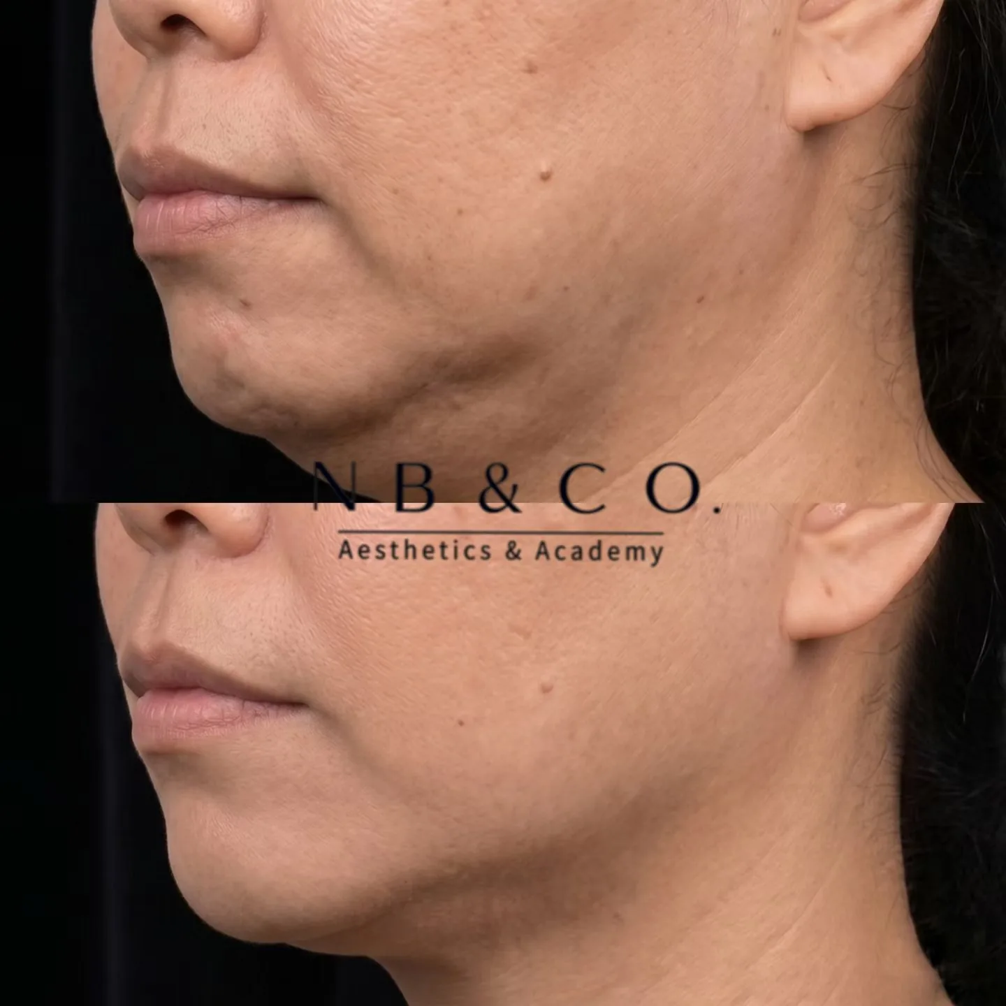 Ultherapy Prime client result before and after at NB&CO. Melbourne