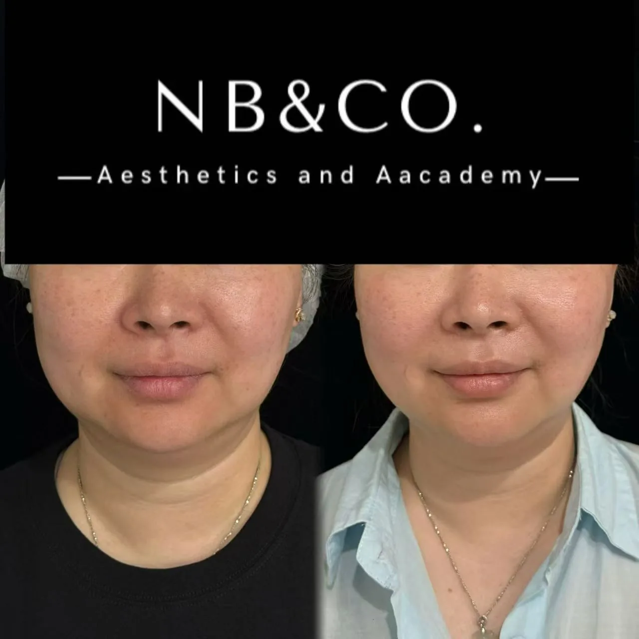 Ultherapy · Real Client Result