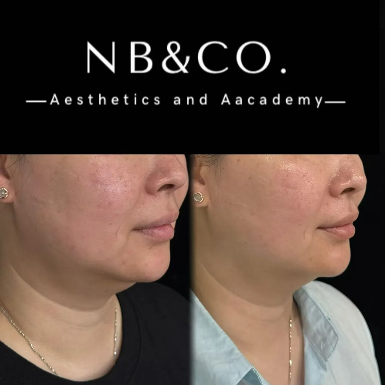 Ultherapy Prime jawline contouring result 2 months after treatment at NB&CO. Melbourne